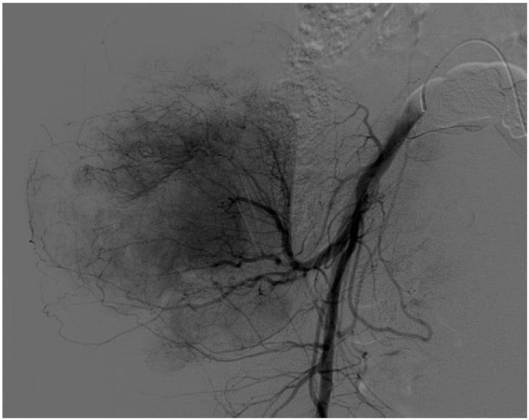 Pelvic angiogram showing dense tumour vascularity before selective embolisation