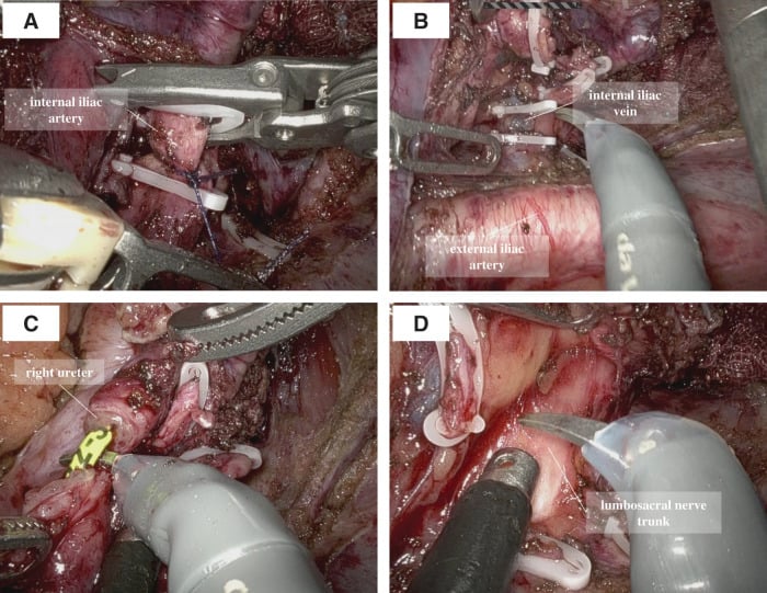 Four operative views, A to D, showing the clipped internal iliac artery and vein, the external iliac artery, the right ureter and the lumbosacral nerve trunk