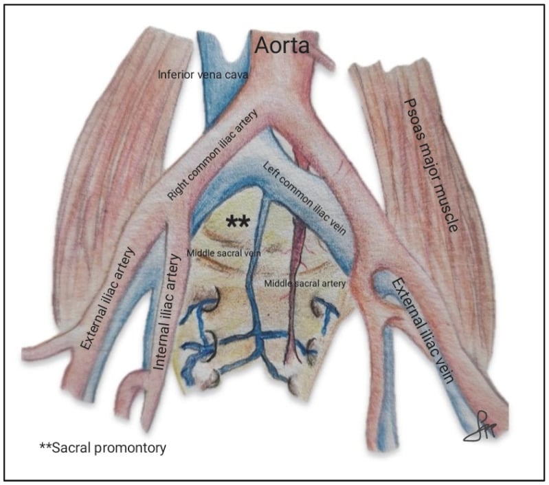 Anatomical diagram of the aortic bifurcation, iliac vessels and middle sacral vessels over the sacral promontory