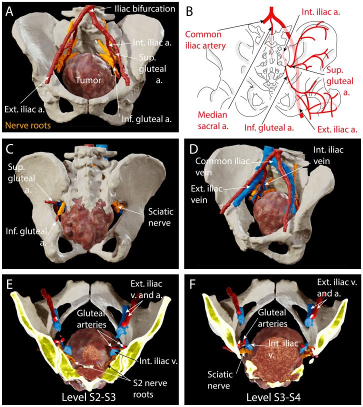 Three-dimensional pelvic models showing a sacral tumour in relation to iliac vessels, gluteal arteries, sciatic nerve and S2 roots