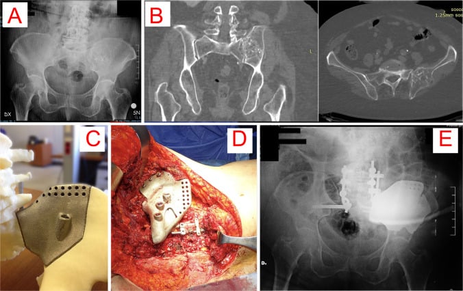 Five panels, A to E: pelvic radiograph, coronal and axial CT, custom implant on a pelvic model, operative view and postoperative radiograph of a custom sacroiliac reconstruction with lumbopelvic screws and rods