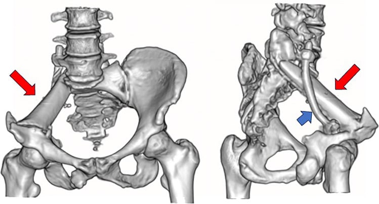 Anterior and oblique three-dimensional reconstructions of a tibial allograft strut spanning an iliac-sacral defect, marked by red arrows, with a rod marked by a blue arrow