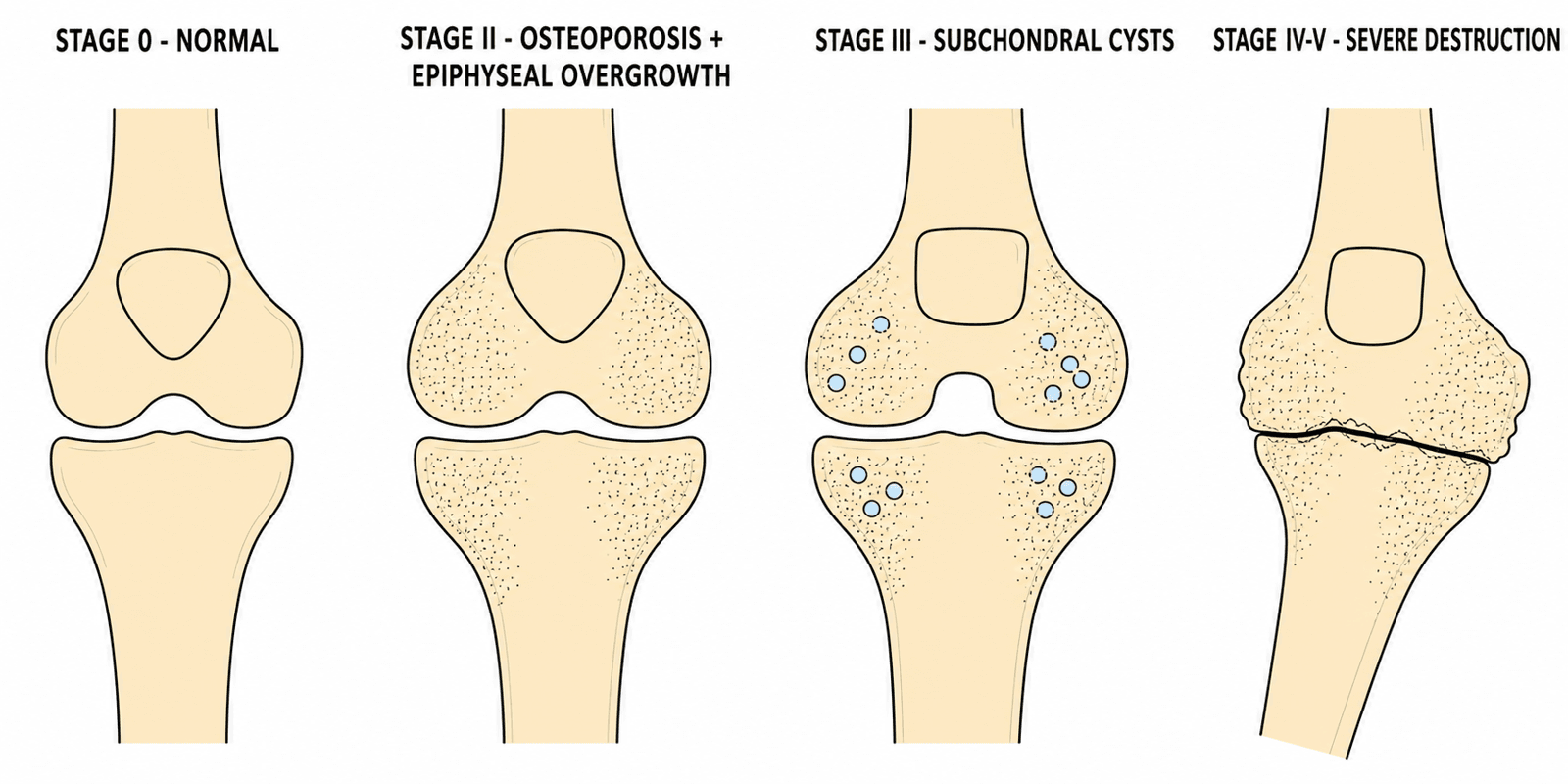 Schematic of Arnold-Hilgartner staging of hemophilic arthropathy on an AP knee, from normal through severe destruction
