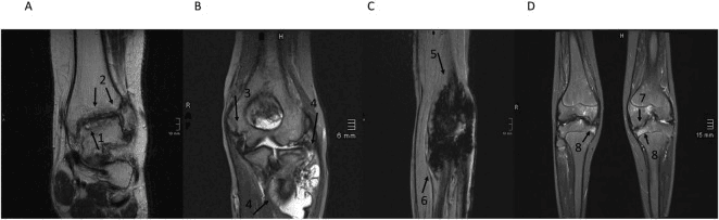 MRI examples of advanced haemophilic ankle, elbow and knee arthropathy