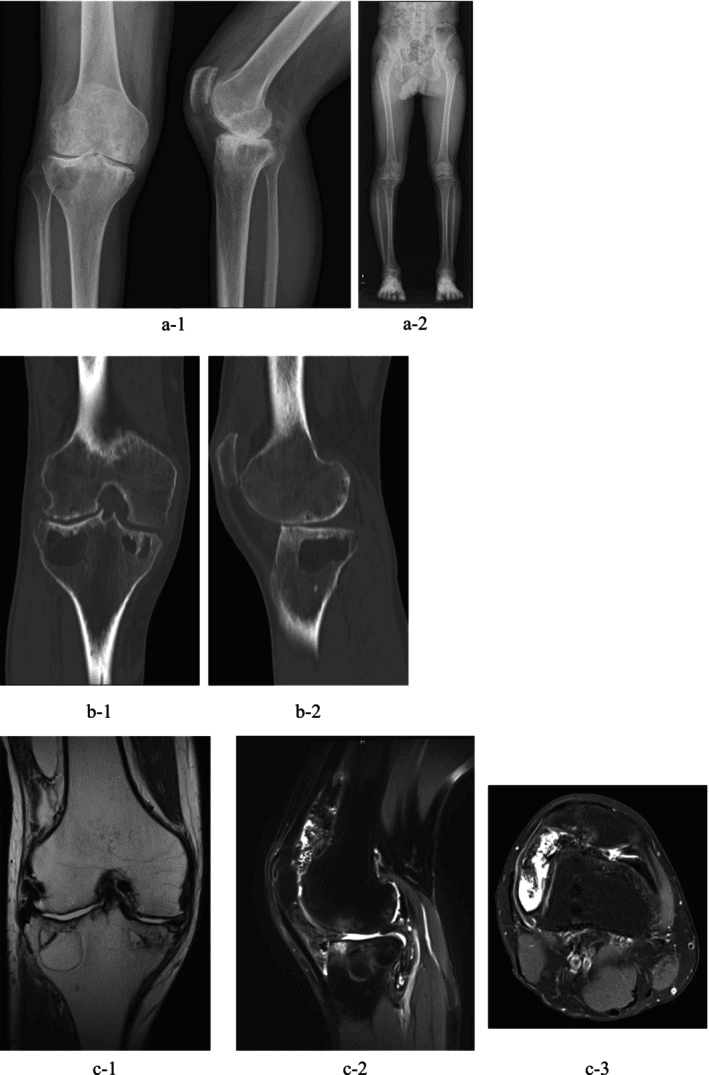 Multimodal imaging of advanced haemophilic knee arthropathy before surgery