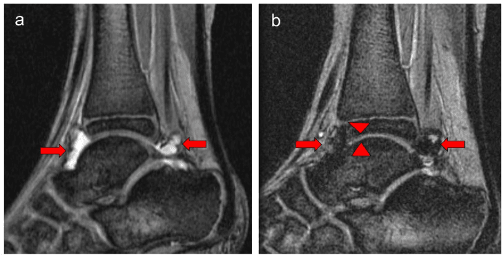 Serial ankle MRI showing haemarthrosis and persistent cartilage loss in severe haemophilia