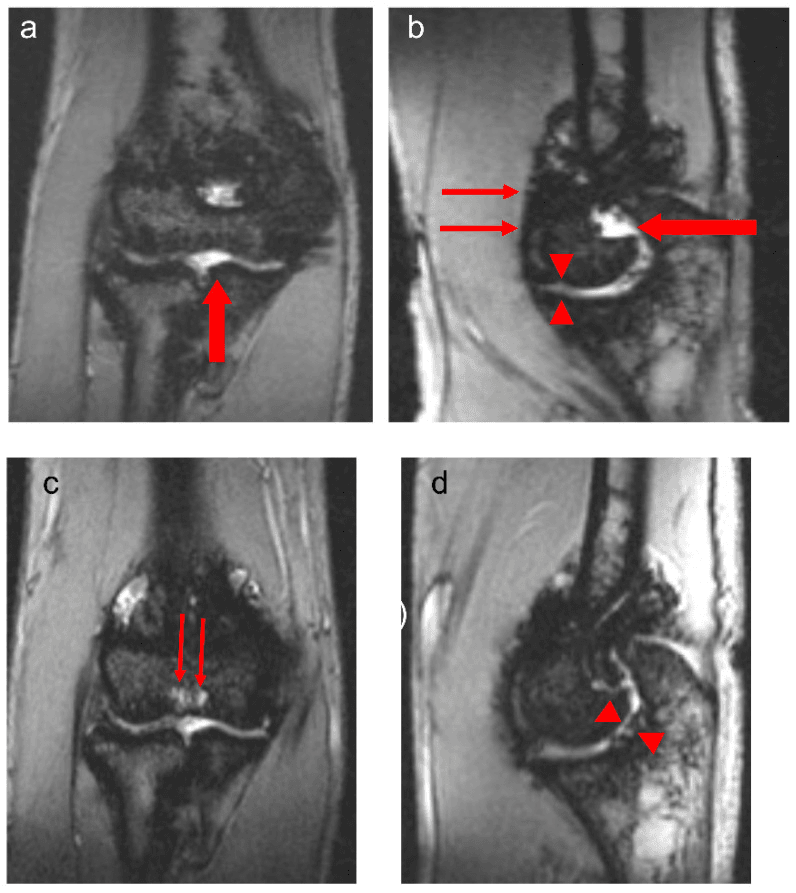 Coronal and sagittal elbow MRI showing haemarthrosis synovial hypertrophy and hemosiderin