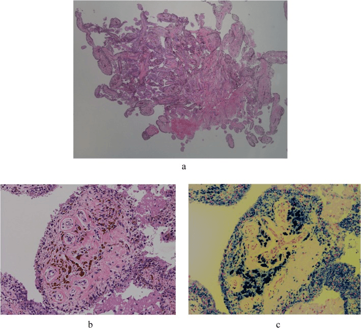 Histology and iron stain showing hemosiderin-laden haemophilic synovium
