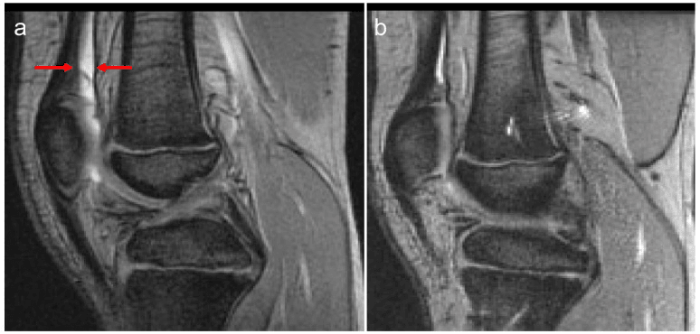 Serial sagittal knee MRI showing interval haemarthrosis changes in severe haemophilia