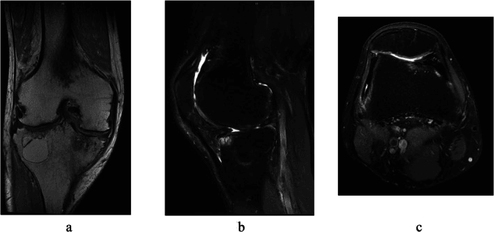 Multiplanar knee MRI after treatment of severe haemophilic arthropathy