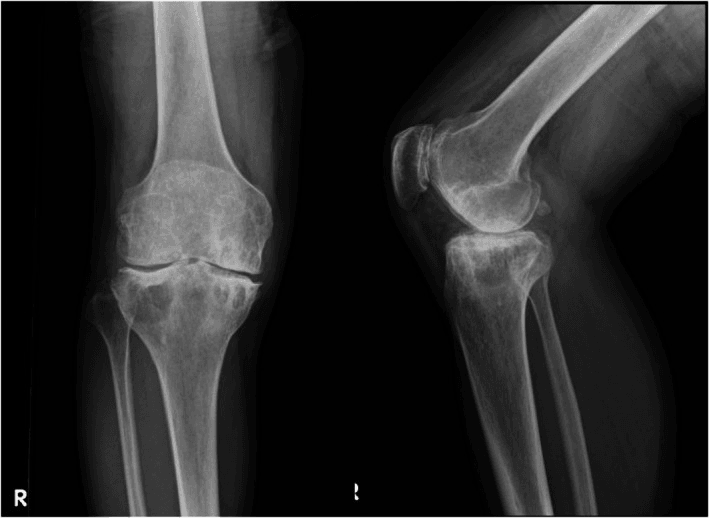 Follow-up knee radiographs after surgery for haemophilic arthropathy