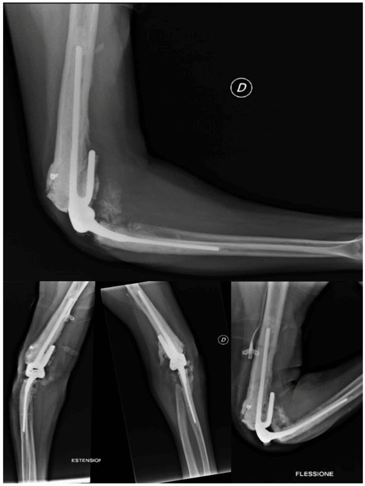 Elbow radiographs after revision arthroplasty for haemophilic arthropathy