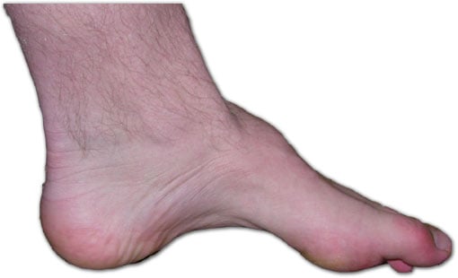 Clinical photograph of the foot of a person with Charcot-Marie-Tooth disease showing pes cavus and clawing
