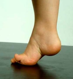Clinical photograph of a foot with a high plantar arch (pes cavus) lifted off the ground