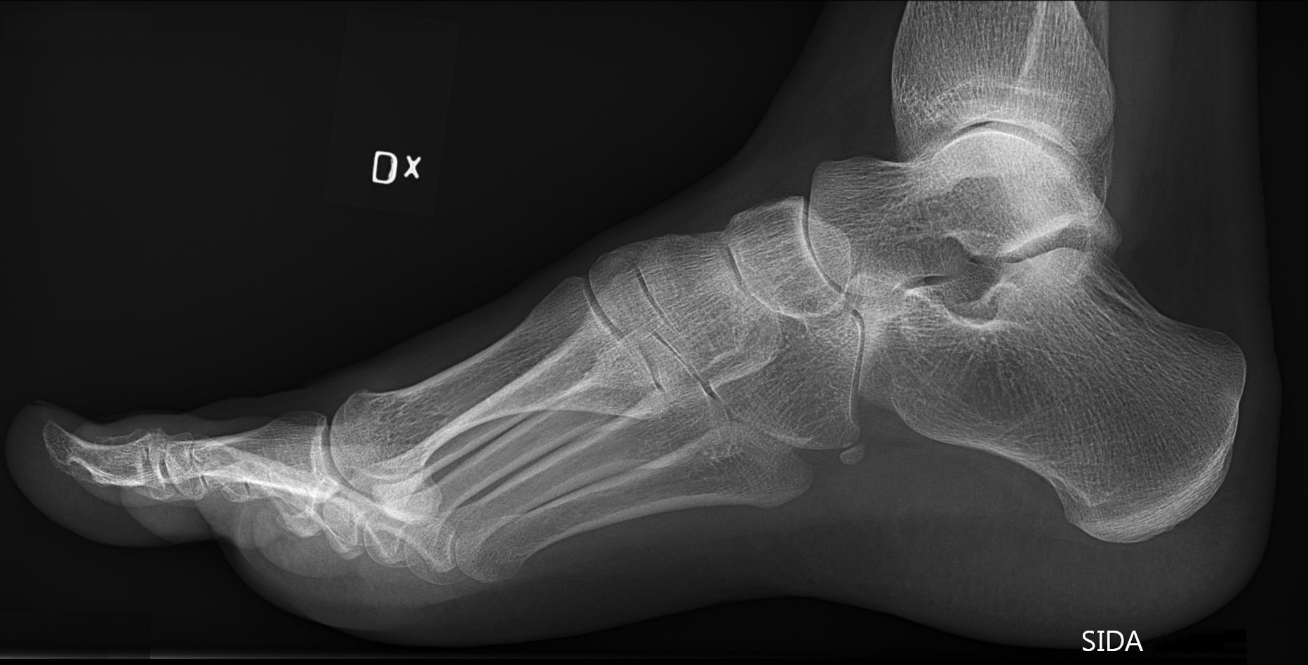 Lateral foot radiograph demonstrating pes cavus