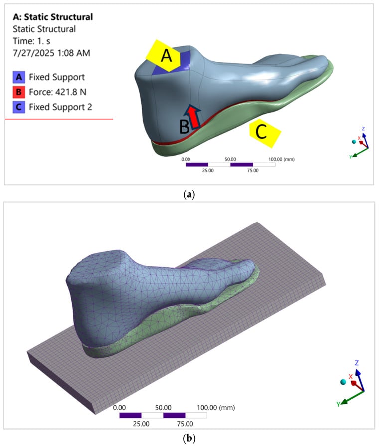3D finite element model of foot-insole system in Hereditary Spastic Paraplegia