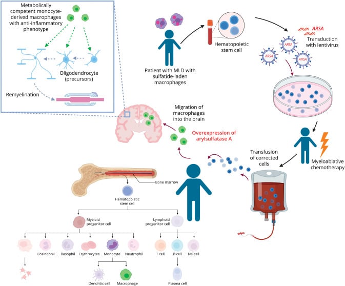 Hematopoietic stem cell gene therapy mechanism and treatment timeline in MLD