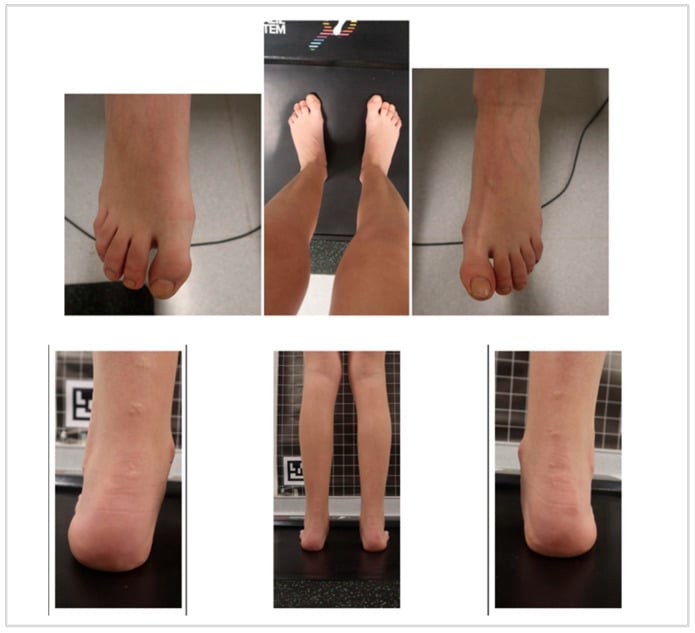 Clinical photographs of both feet showing pes planovalgus and hallux valgus in a child with hereditary spastic paraplegia