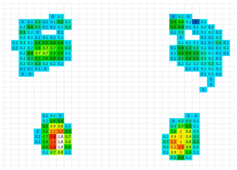 Plantar pressure distribution map of both feet in a child with hereditary spastic paraplegia and pes planovalgus