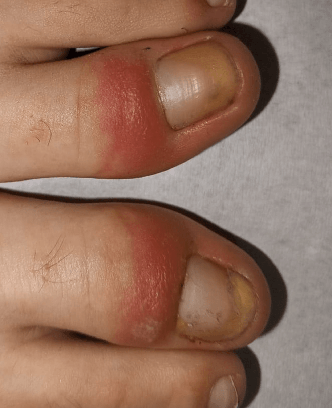 Close-up of the proximal nail fold showing erythema, oedema, loss of the cuticle and a thickened yellowish nail plate