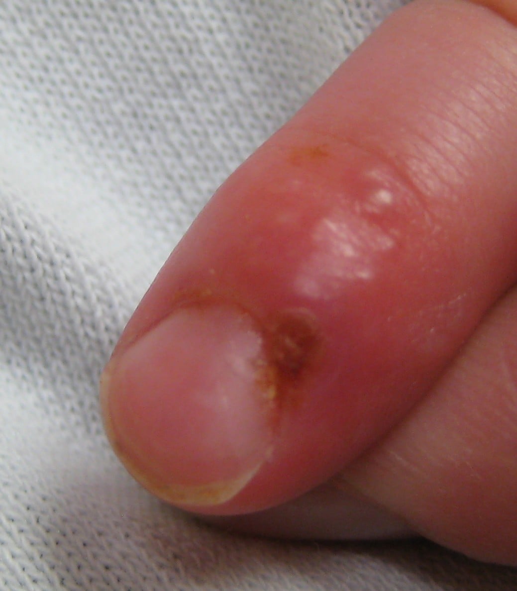Clinical photograph of a fingertip with herpetic whitlow showing grouped vesicles on an erythematous swollen distal finger