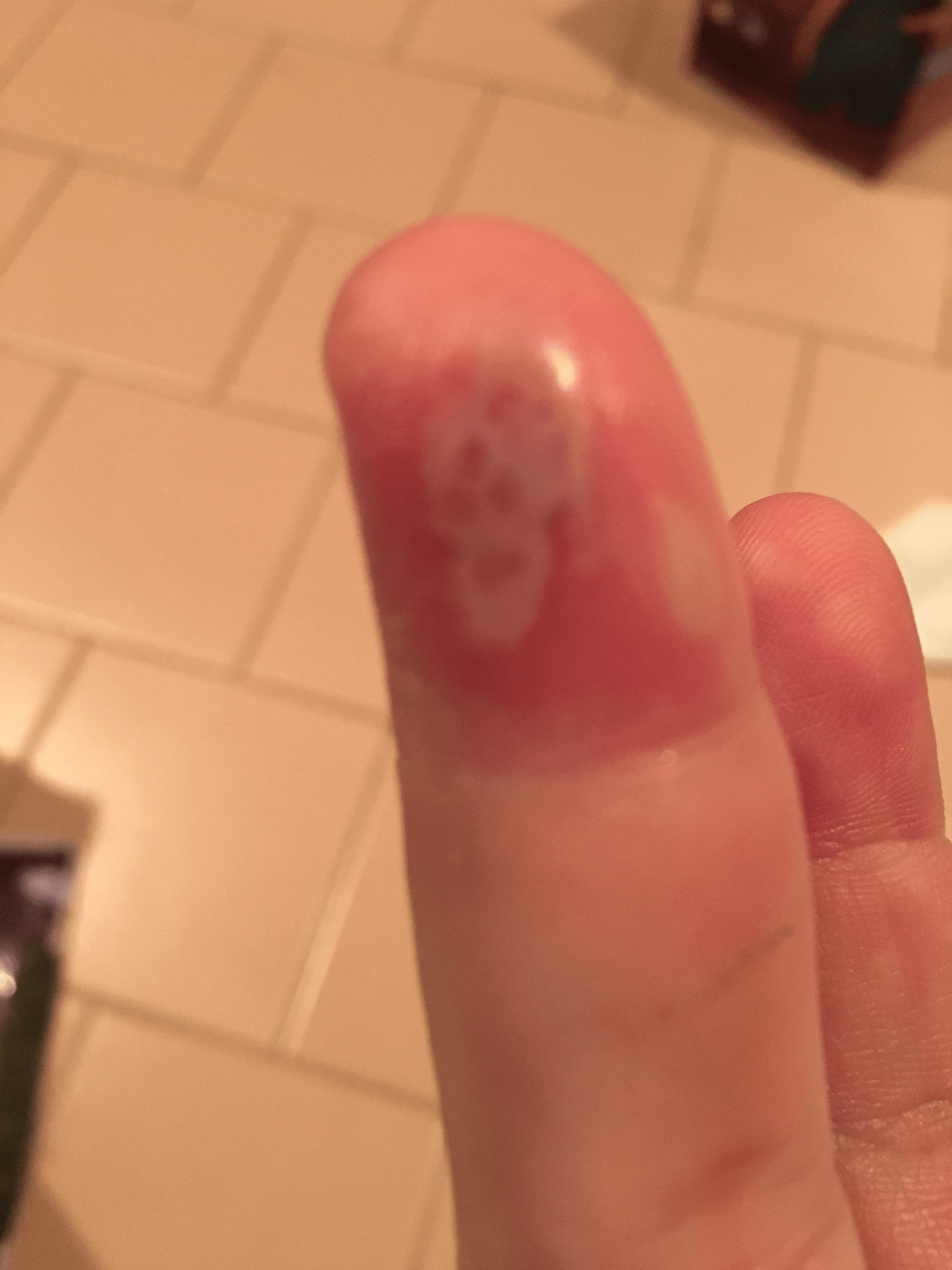 Clinical photograph of grouped cloudy vesicles on an erythematous base at the thumb in herpetic whitlow