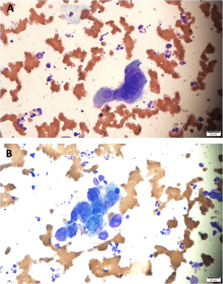 Giemsa-stained Tzanck smear showing multinucleated squamous cells with nuclear moulding and ground-glass chromatin