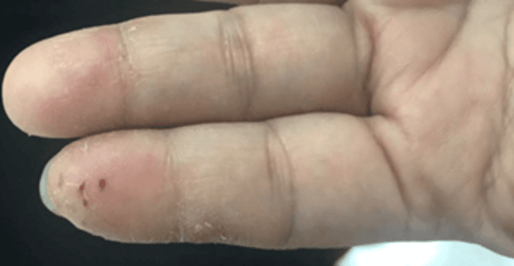 Eroded group of vesicles on an erythematous base over the index finger before treatment