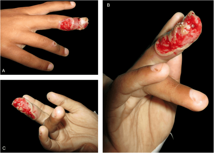 Clinical photographs of extensive finger ulceration outlined by a whitish epidermal flap with periungual involvement and an umbilicated vesicle