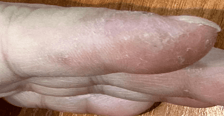 The same finger after treatment showing complete resolution of the whitlow lesion