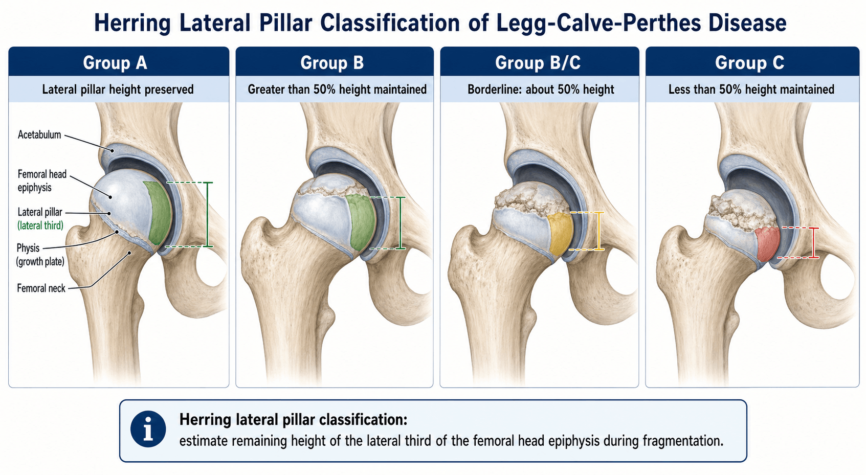 Herring Lateral Pillar Classification of Perthes