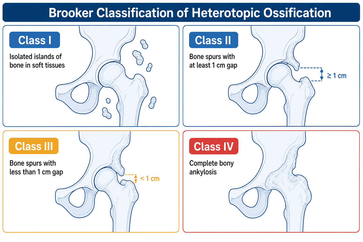 Brooker classification of heterotopic ossification