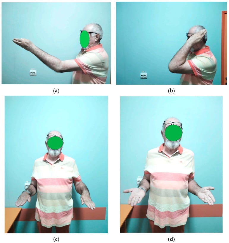 Clinical views documenting elbow extension, flexion, pronation and supination after heterotopic ossification surgery.