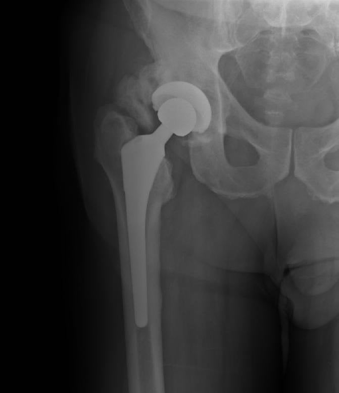 AP hip radiograph after total hip arthroplasty showing heterotopic ossification in the soft tissues around the prosthesis.