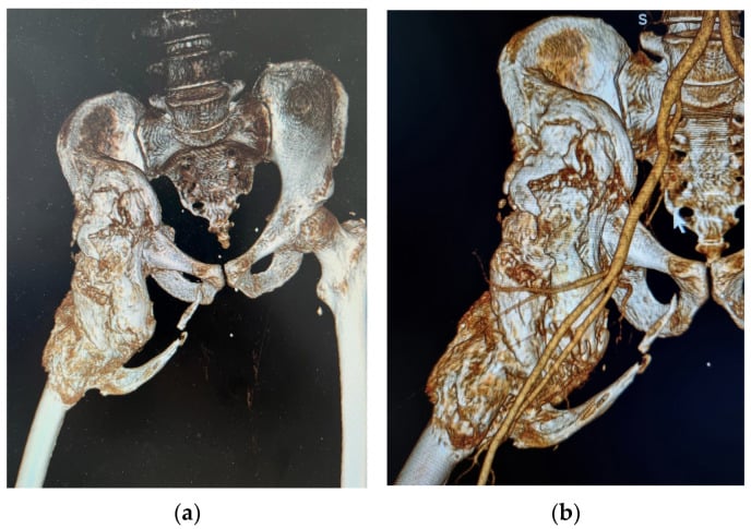 Three-dimensional CT reconstruction showing giant iliofemoral heterotopic ossification and nearby vessels for operative planning.