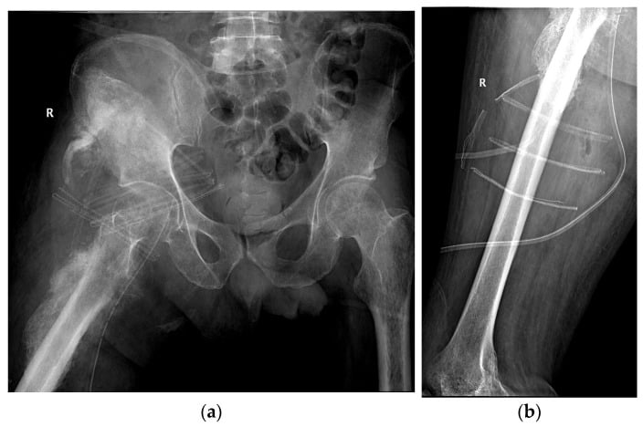 Postoperative Lowenstein and lateral femoral radiographs after resection of giant iliofemoral heterotopic ossification.