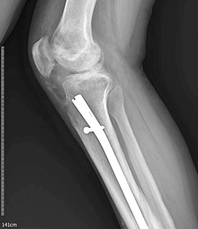 Early postoperative lateral knee radiograph after excision of heterotopic ossification.