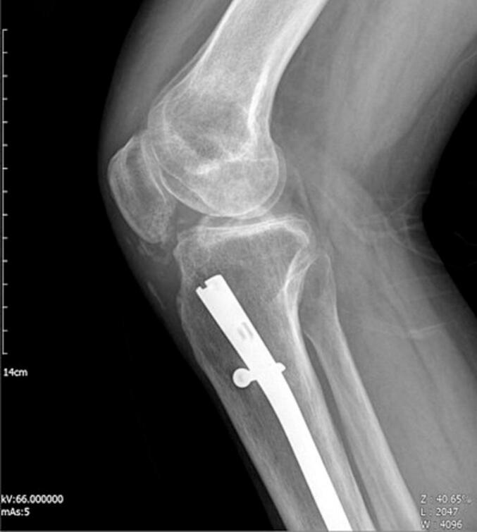 Lateral knee radiograph showing early recurrent Brooker grade I heterotopic ossification after excision.