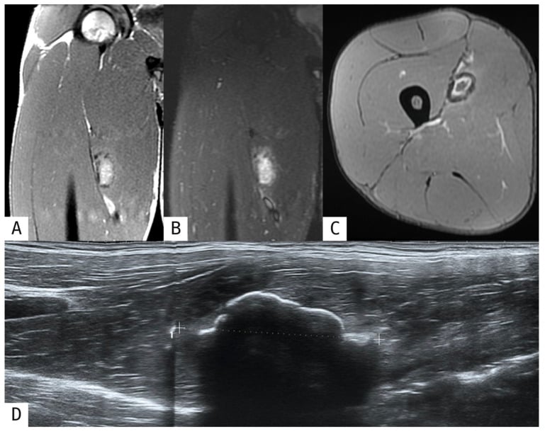 Coronal and axial MRI with ultrasound showing post-traumatic myositis ossificans in the adductor longus.