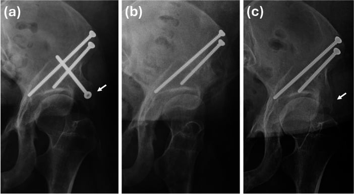 Serial hip radiographs showing diffuse heterotopic bone after periacetabular osteotomy, excision and recurrence.
