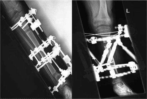 Side-by-side photographs of an Ilizarov ring fixator and a Taylor Spatial Frame