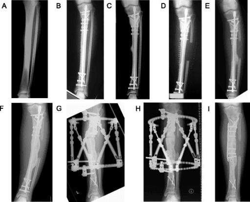 Anteroposterior radiographs of left tibia showing osteoblastic lesion before and appearances after surgery