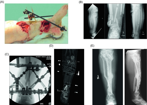 Clinical photographs of large open anteromedial wounds over the lower leg