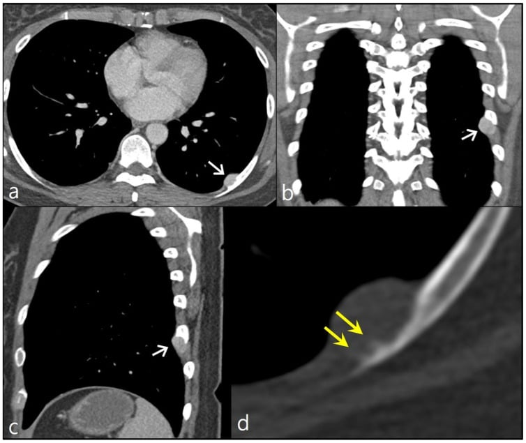 CT showing a rib surface mass with cortical erosion and perpendicular sunburst periosteal reaction in high-grade surface osteosarcoma