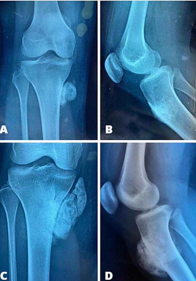 AP radiograph and 3D CT reconstruction of distal femur surface osteosarcoma