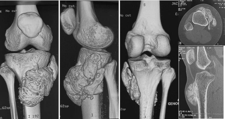 Coronal T1 and T2 MRI demonstrating juxtacortical surface osteosarcoma mass