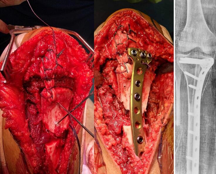 3D CT surgical planning template for surface osteosarcoma resection