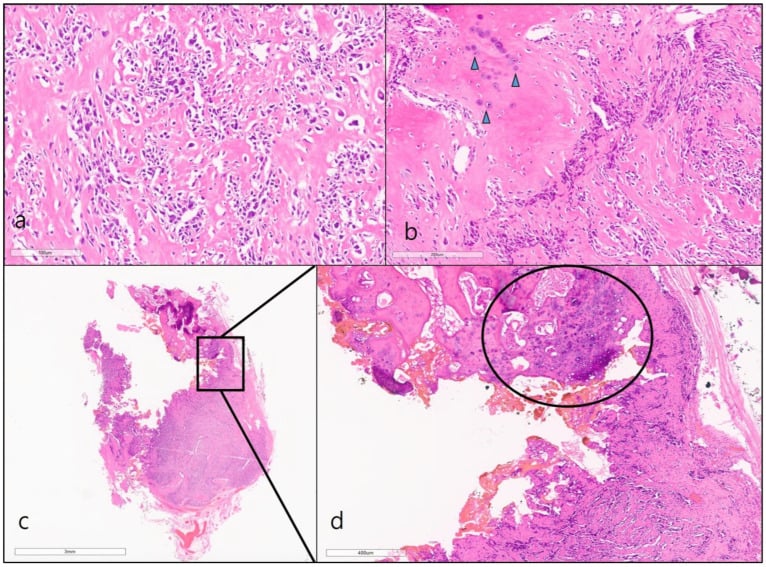Histology of high-grade surface osteosarcoma showing pleomorphic spindle cells, woven bone, and medullary extension