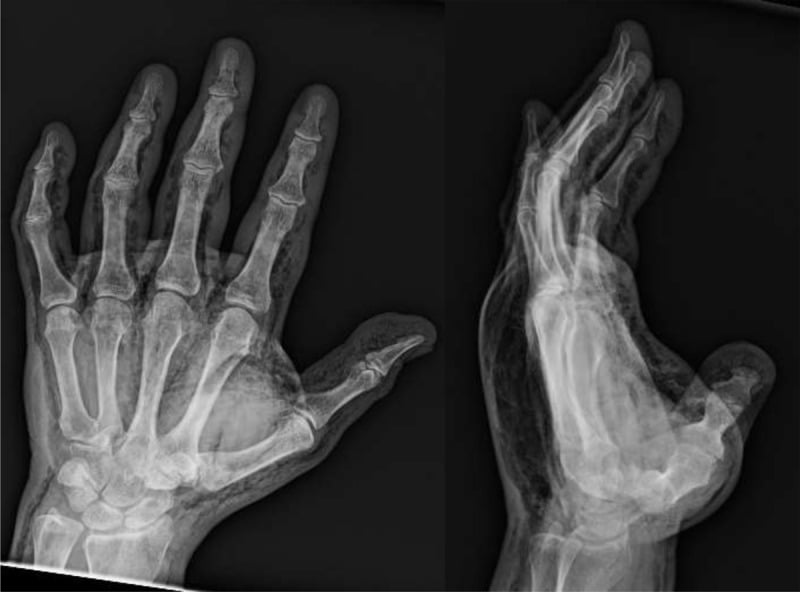 Hand radiographs showing diffuse subcutaneous emphysema after helium high-pressure injection injury.