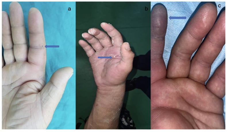 Clinical examples of small punctiform high-pressure injection entry wounds in the hand.